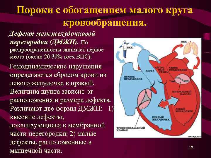 Пороки с обогащением малого круга кровообращения. Дефект межжелудочковой перегородки (ДМЖП). По распространенности занимает первое