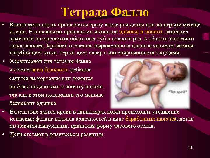 Тетрада Фалло • Клинически порок проявляется сразу после рождения или на первом месяце жизни.