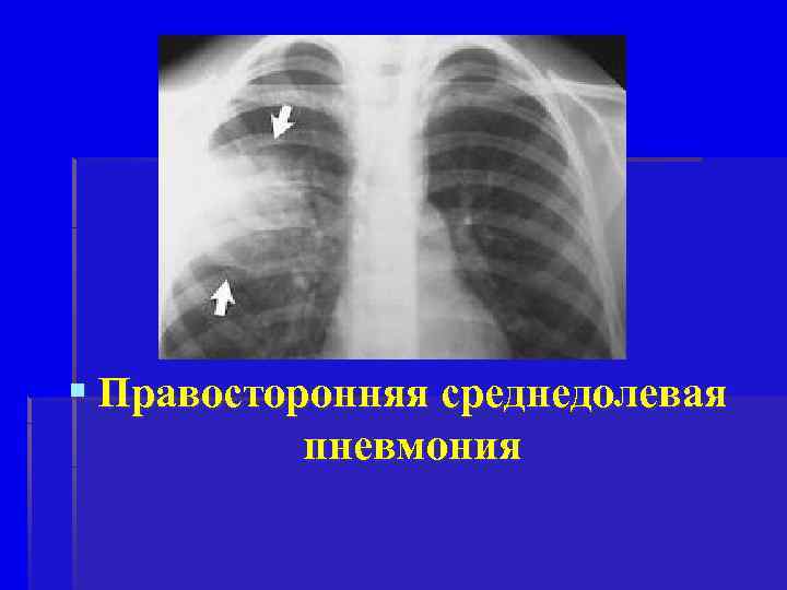 § Правосторонняя среднедолевая пневмония 
