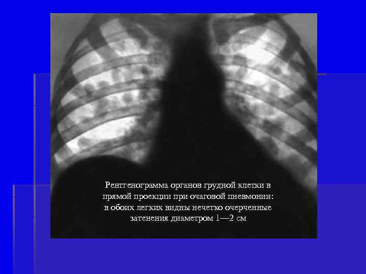 Рентгенограмма органов грудной клетки в прямой проекции при очаговой пневмонии: в обоих легких видны