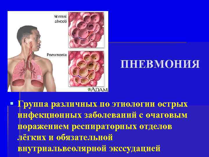 ПНЕВМОНИЯ § Группа различных по этиологии острых инфекционных заболеваний с очаговым поражением респираторных отделов