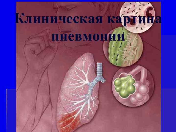 Клиническая картина пневмонии 