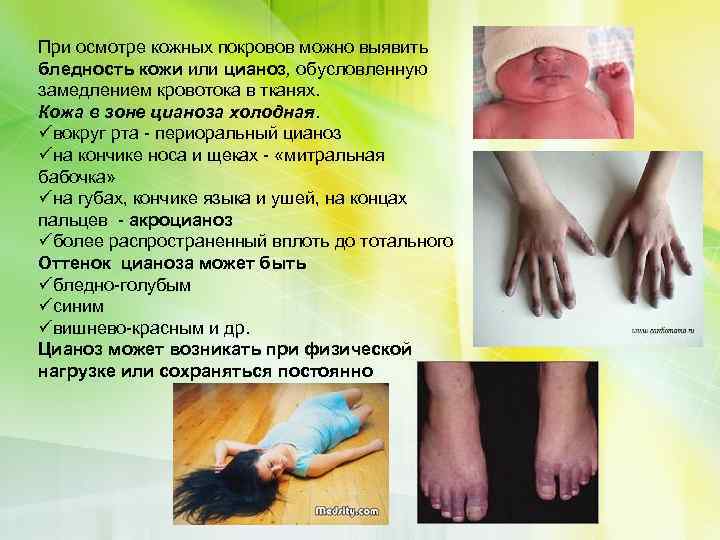 При осмотре кожных покровов можно выявить бледность кожи или цианоз, обусловленную замедлением кровотока в