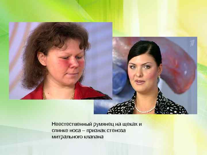 Неестественный румянец на щеках и спинке носа – признак стеноза митрального клапана 
