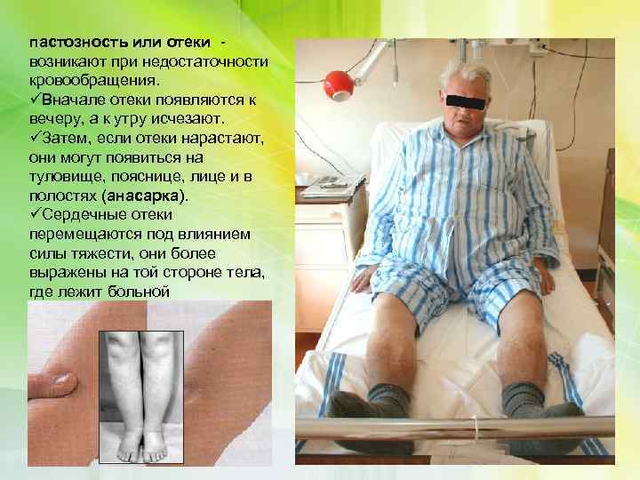 пастозность или отеки возникают при недостаточности кровообращения. üВначале отеки появляются к вечеру, а к