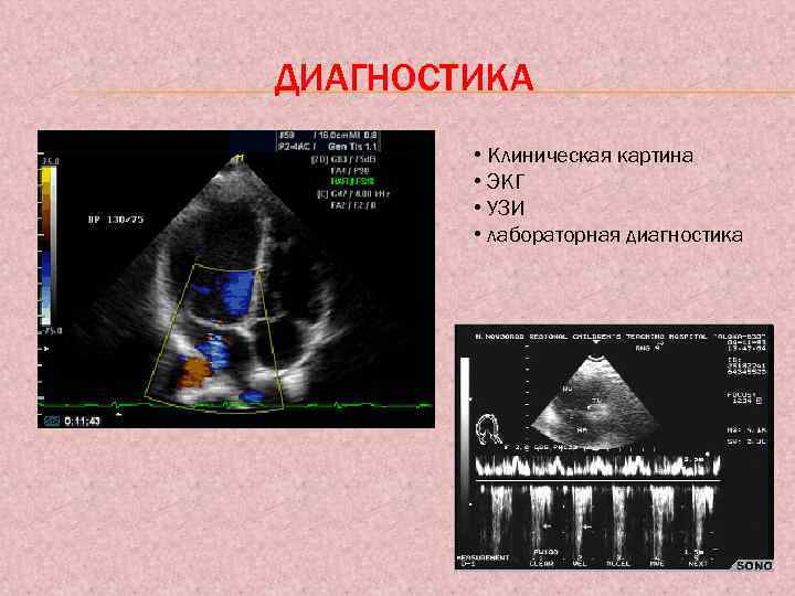 ДИАГНОСТИКА • Клиническая картина • ЭКГ • УЗИ • лабораторная диагностика 