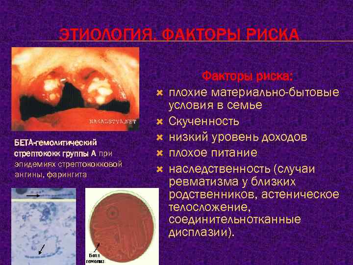 ЭТИОЛОГИЯ. ФАКТОРЫ РИСКА БЕТА-гемолитический стрептококк группы А при эпидемиях стрептококковой ангины, фарингита Факторы риска: