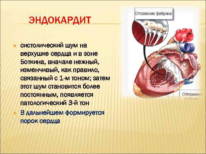 ЭНДОКАРДИТ систолический шум на верхушке сердца и в зоне Боткина, вначале нежный, изменчивый, как