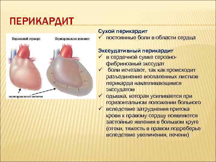 ПЕРИКАРДИТ Сухой перикардит ü постоянные боли в области сердца Экссудативный перикардит ü в сердечной