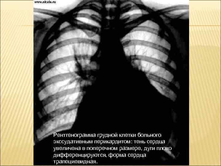 Рентгенограмма грудной клетки больного экссудативным перикардитом: тень сердца увеличена в поперечном размере, дуги плохо