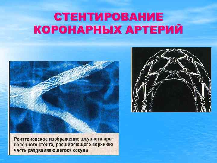 СТЕНТИРОВАНИЕ КОРОНАРНЫХ АРТЕРИЙ 