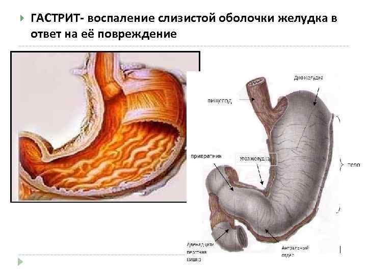  ГАСТРИТ- воспаление слизистой оболочки желудка в ответ на её повреждение 