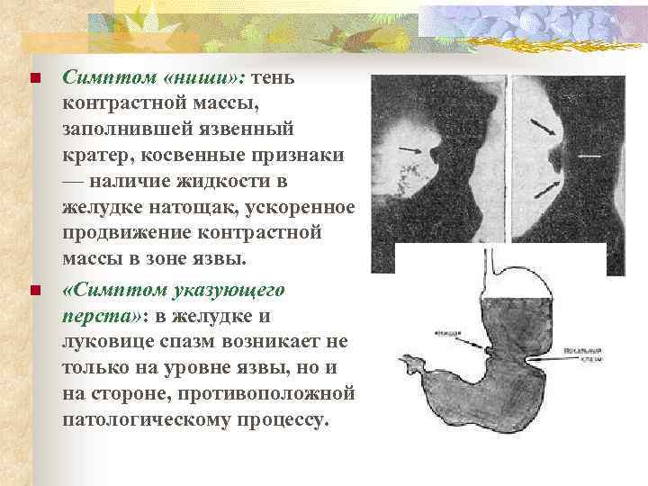 n n Симптом «ниши» : тень контрастной массы, заполнившей язвенный кратер, косвенные признаки —