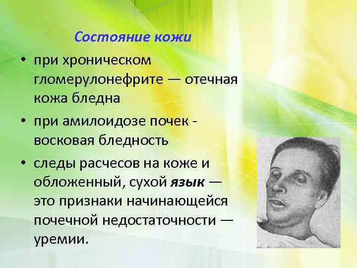 Состояние кожи • при хроническом гломерулонефрите — отечная кожа бледна • при амилоидозе почек