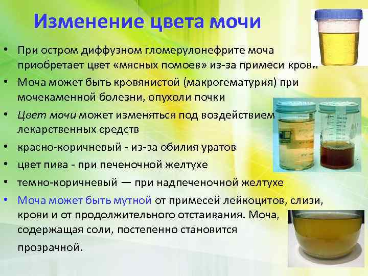 Изменение цвета мочи • При остром диффузном гломерулонефрите моча приобретает цвет «мясных помоев» из-за