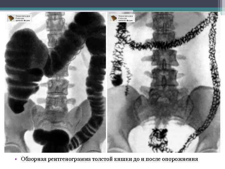  • Обзорная рентгенограмма толстой кишки до и после опорожнения 