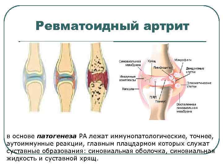 Ревматоидный артрит в основе патогенеза РА лежат иммунопатологические, точнее, аутоиммунные реакции, главным плацдармом которых