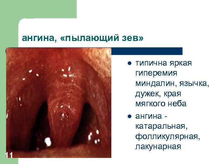 ангина, «пылающий зев» l l 11 типична яркая гиперемия миндалин, язычка, дужек, края мягкого