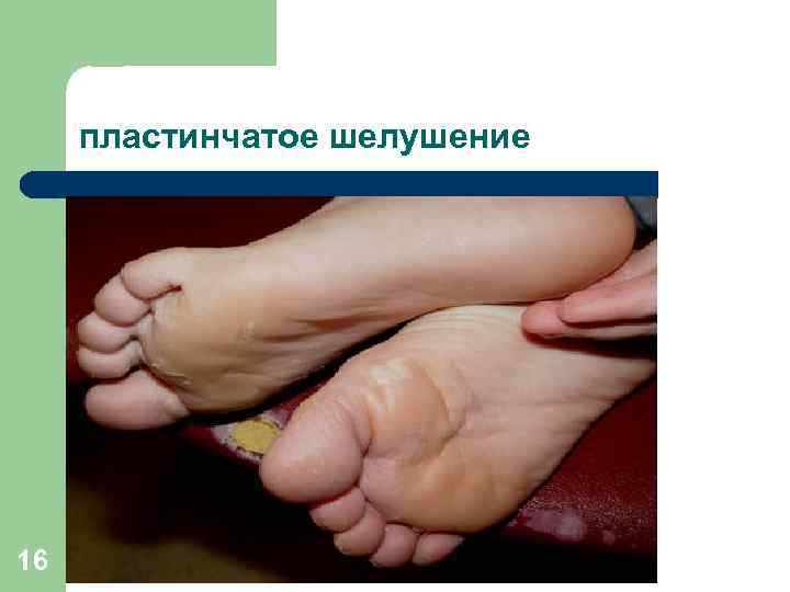 пластинчатое шелушение 16 