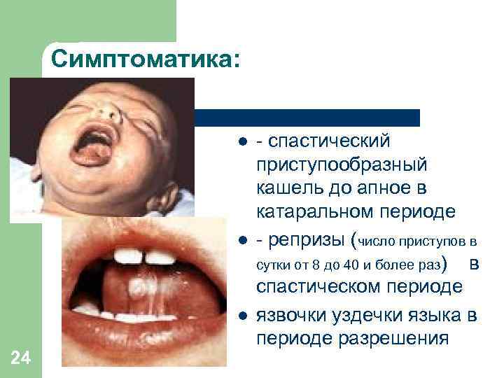 Симптоматика: l l l 24 - спастический приступообразный кашель до апное в катаральном периоде
