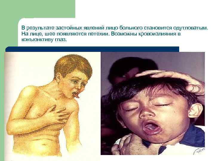 В результате застойных явлений лицо больного становится одутловатым. На лице, шее появляются петехии. Возможны