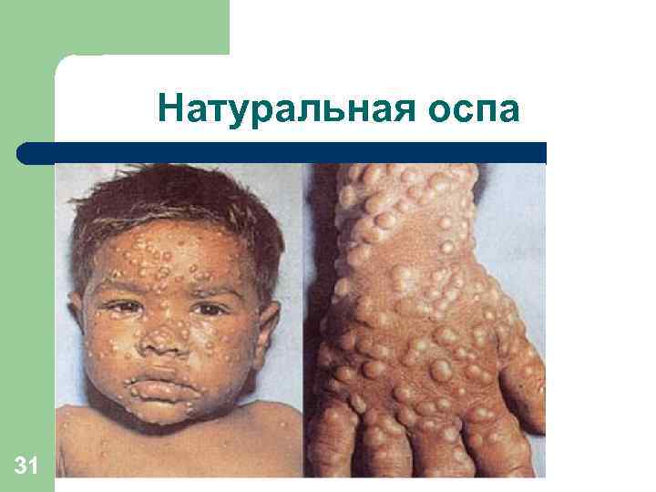 Натуральная оспа 31 