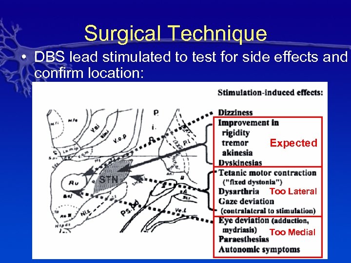 Surgical Technique • DBS lead stimulated to test for side effects and confirm location: