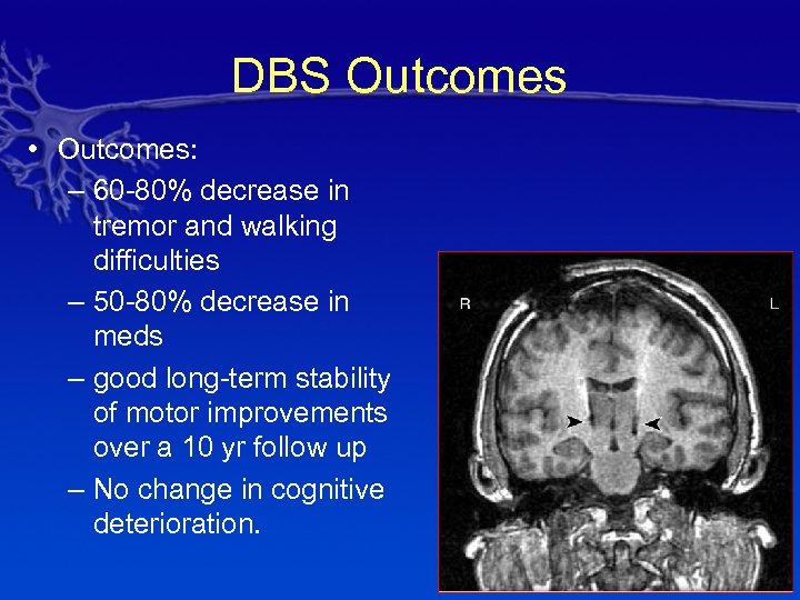 DBS Outcomes • Outcomes: – 60 -80% decrease in tremor and walking difficulties –