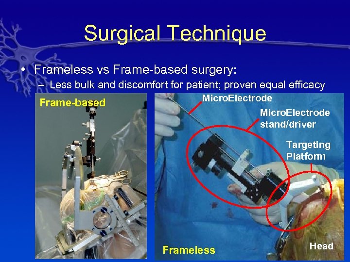 Surgical Technique • Frameless vs Frame-based surgery: – Less bulk and discomfort for patient;