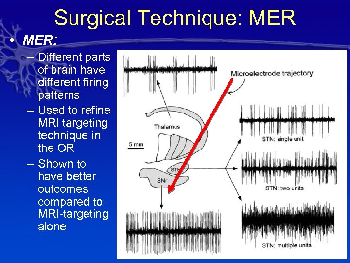 Surgical Technique: MER • MER: – Different parts of brain have different firing patterns