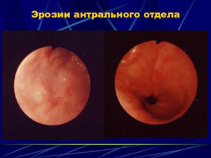 Эрозии антрального отдела 