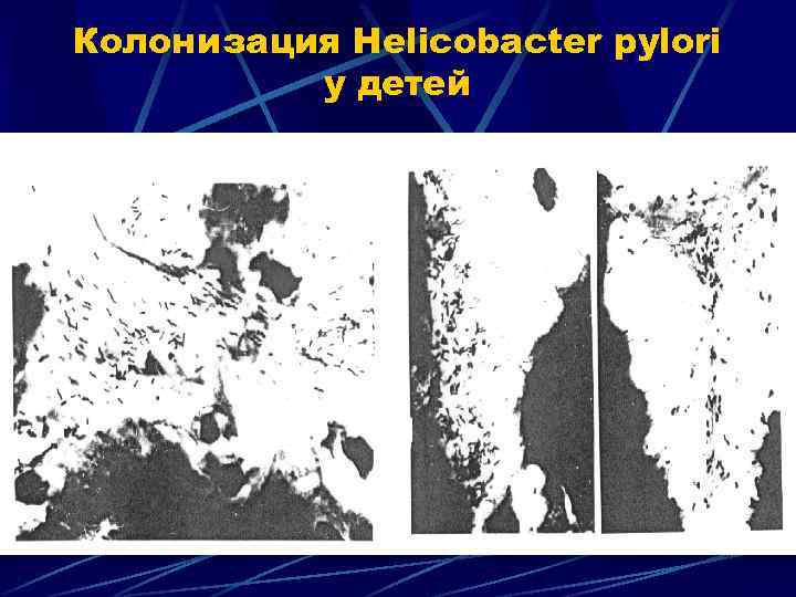 Колонизация Helicobacter pylori у детей 
