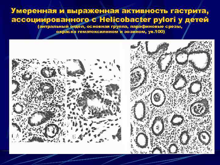Умеренная и выраженная активность гастрита, ассоциированного с Helicobacter pylori у детей (антральный отдел, основная