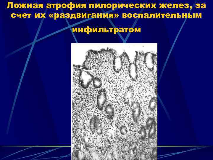 Ложная атрофия пилорических желез, за счет их «раздвигания» воспалительным инфильтратом 