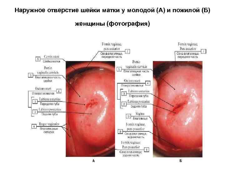 Наружное отверстие шейки матки у молодой (А) и пожилой (Б) женщины (фотография) 