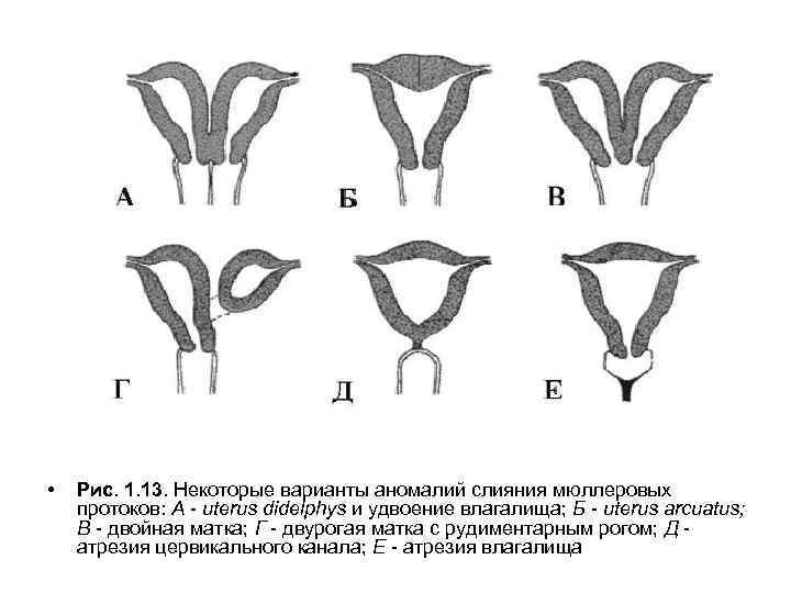  • Рис. 1. 13. Некоторые варианты аномалий слияния мюллеровых протоков: А - uterus