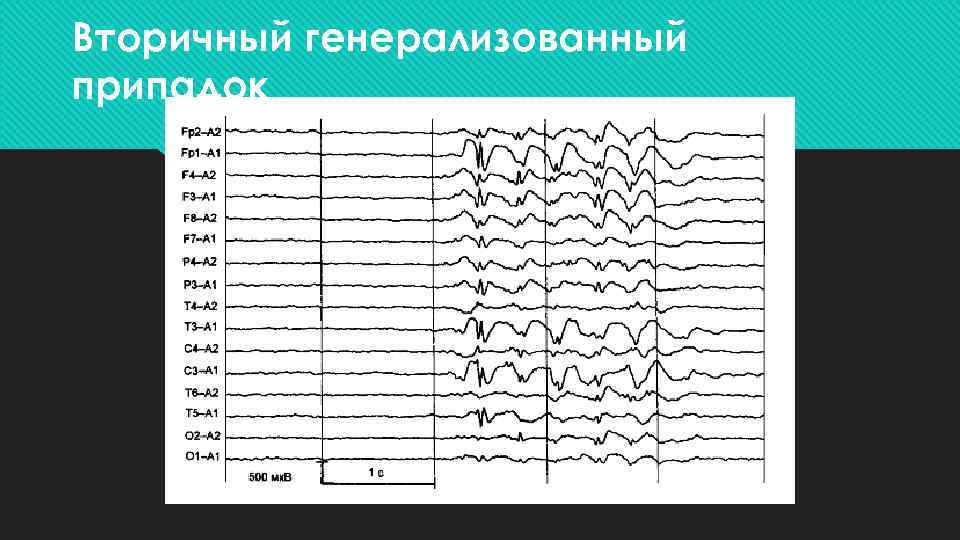 Вторичный генерализованный припадок 