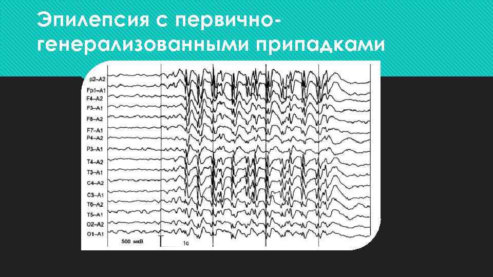 Эпилепсия с первичногенерализованными припадками 