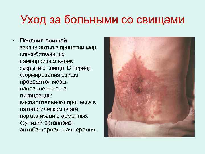 Уход за больными со свищами • Лечение свищей заключается в принятии мер, способствующих самопроизвольному