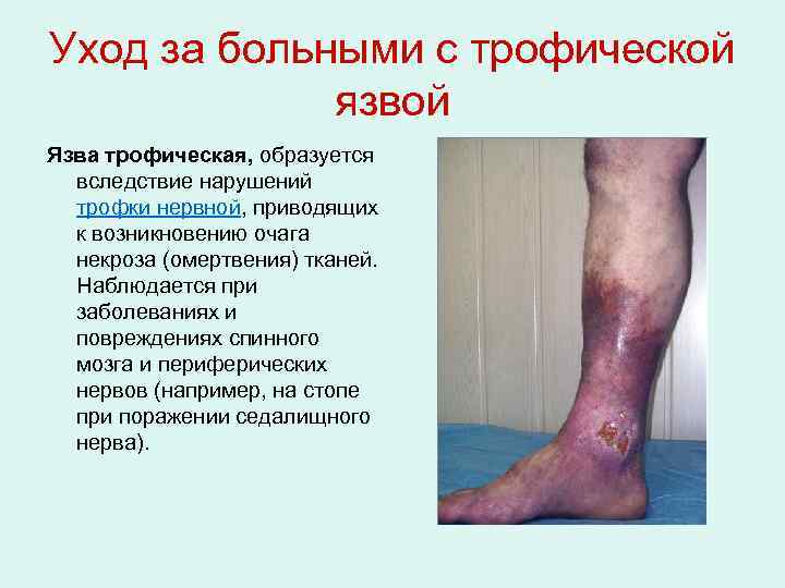 Уход за больными с трофической язвой Язва трофическая, образуется вследствие нарушений трофки нервной, приводящих