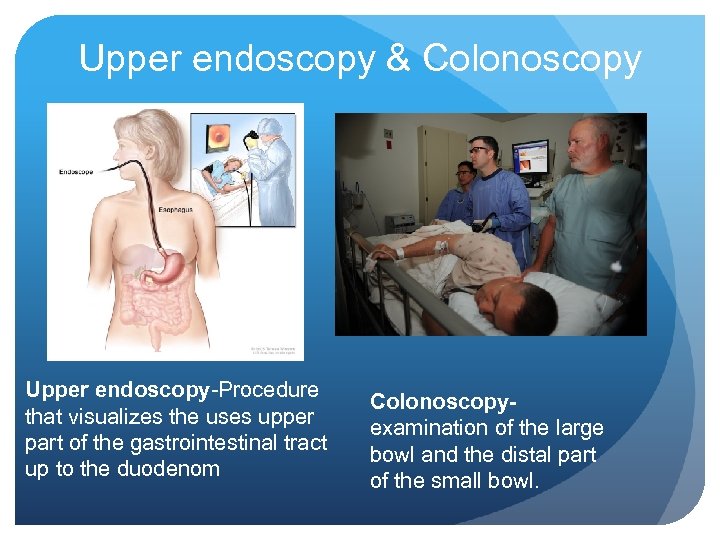 Upper endoscopy & Colonoscopy Upper endoscopy-Procedure that visualizes the uses upper part of the