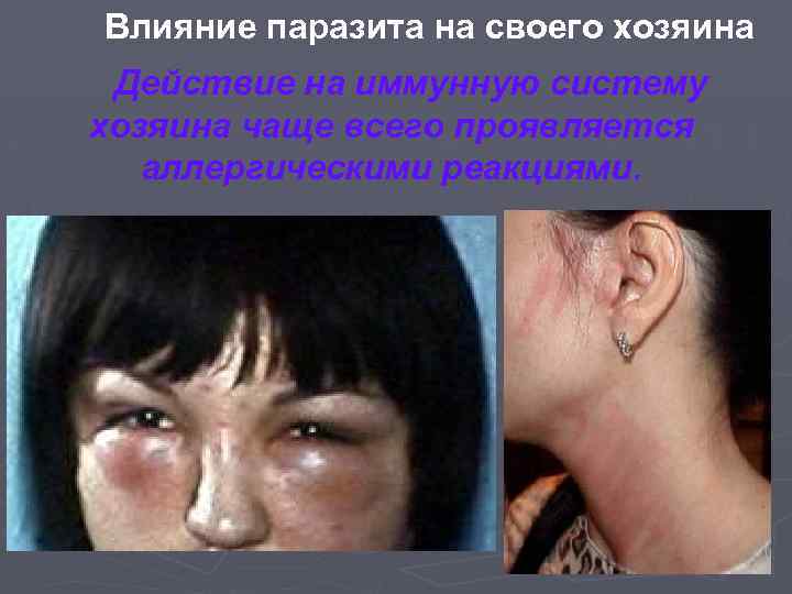 Влияние паразита на своего хозяина Действие на иммунную систему хозяина чаще всего проявляется аллергическими
