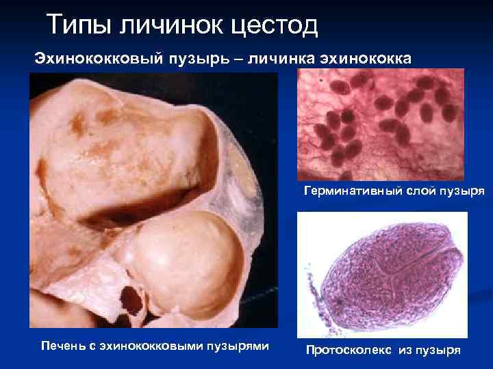 Типы личинок цестод Эхинококковый пузырь – личинка эхинококка найти Герминативный слой пузыря Печень с