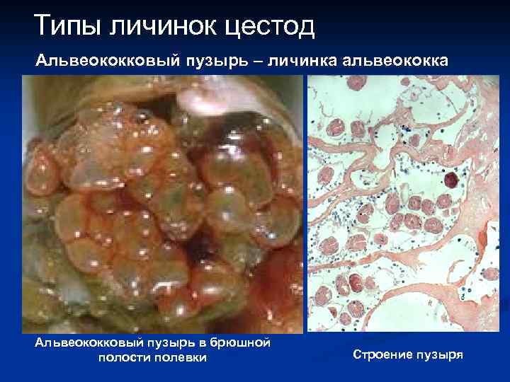 Типы личинок цестод Альвеококковый пузырь – личинка альвеококка найти Альвеококковый пузырь в брюшной полости