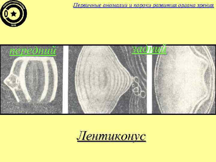 Первичные аномалии и пороки развития органа зрения передний задний Лентиконус 