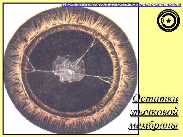 Первичные аномалии и пороки развития органа зрения Остатки зрачковой мембраны 