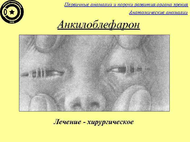 Первичные аномалии и пороки развития органа зрения Анатомические аномалии Анкилоблефарон Лечение - хирургическое 