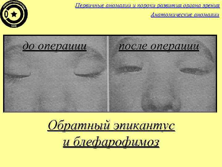 Первичные аномалии и пороки развития органа зрения Анатомические аномалии до операции после операции Обратный