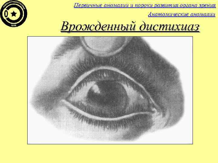 Первичные аномалии и пороки развития органа зрения Анатомические аномалии Врожденный дистихиаз 