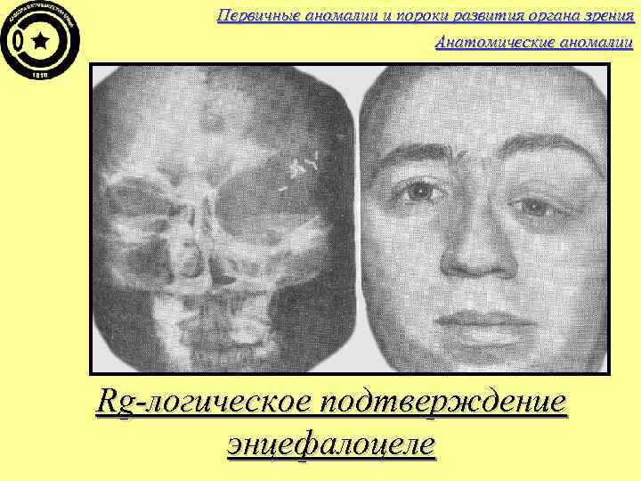 Первичные аномалии и пороки развития органа зрения Анатомические аномалии Rg-логическое подтверждение энцефалоцеле 